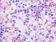 Marrow Histiocytosis - 6.