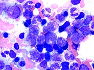Granulocytic Hyperplasia - 1.