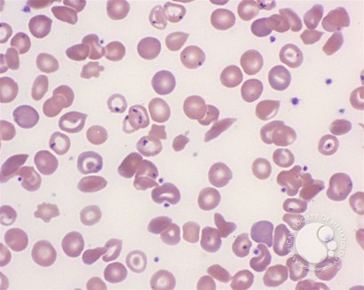 Pappenheimer Bodies in Sickle Cell Disease - 2.