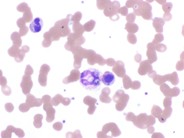 Histoplasma Capsulatum WBC Inclusions - 1.