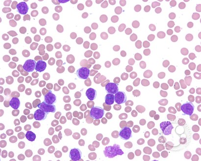 Peripheralizing Follicular Lymphoma with Atypical Morphology - 1.