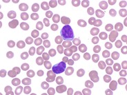 Peripheralizing Follicular Lymphoma with Atypical Morphology - 1.