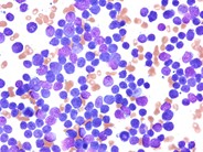 Peripheralizing Follicular Lymphoma with Atypical Morphology - 5.