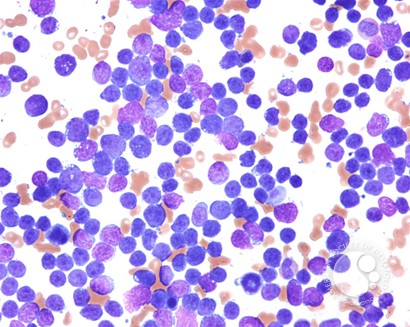 Peripheralizing Follicular Lymphoma with Atypical Morphology - 5.