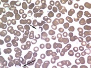 Pseudoschistocytosis secondary to cryoglobulinemia - 1.