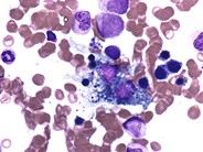 Debris laden histiocytes - 4.