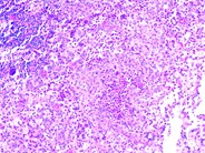 Langerhans cell histiocytosis - 1.