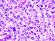 Langerhans cell histiocytosis - 4.