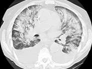 Fungal pneumonia - 1.