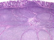 Follicular lymphoma (grade 1/3) in a hepatic flexure polyp - 2.