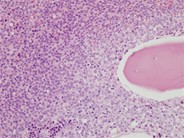 IgD myeloma with marrow fibrosis - 2.