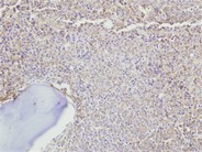 IgD myeloma with marrow fibrosis - 3.