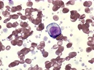 AML with t(3;3)-peripheral blood - 1.