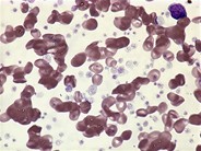 AML with t(3;3)-peripheral blood - 2.
