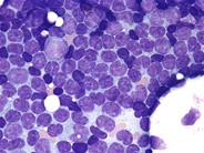 Follicular lymphoma–bone marrow aspirate - 1.