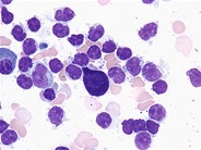 Follicular lymphoma–bone marrow aspirate - 2.