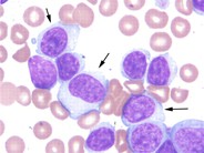 Atypical chronic lymphocytic leukemia - 2.