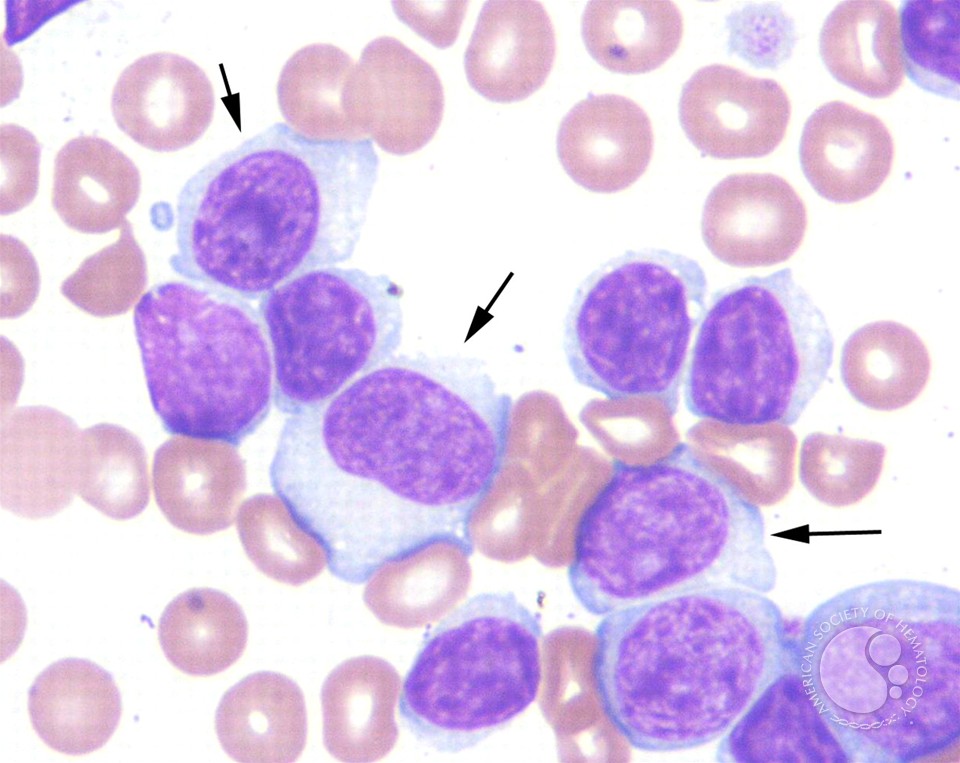 Реактивные лимфоциты в крови. Хронический лимфолейкоз микроскопия. В -лимфоциты хронический лимфолейкоз. Хронический лимфолейкоз бластные клетки. Т клеточный пролимфоцитарный лейкоз.