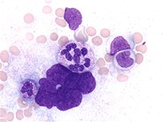 Dysgranulopoiesis - 1.