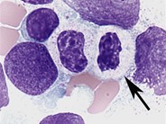 Dysgranulopoiesis - 7.