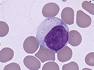 Atypical Lymphocytes With Azurophilic Granules