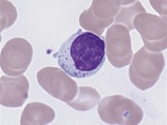 large-granular-lymphocytes-2