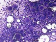 idiopathic thrombocytopenic purpura smear