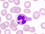 Ehrlichiosis - 1.