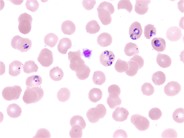 Plasmodium falciparum infection - 2.