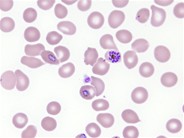 Plasmodium falciparum infection - 3.