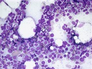 Erythroid hypoplasia - 1.