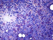 Eosinophilia - bone marrow aspirate - 1.