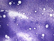Hypercellular bone marrow aspirate - 1.
