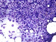 normal bone marrow cells