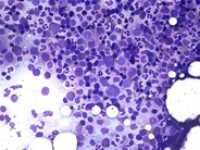 Normal adult bone marrow aspirate - 3.