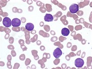 Megakaryocytes and micromegakaryocytes in peripheral blood of a patient ...