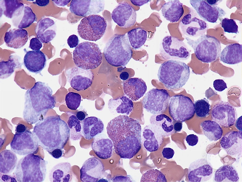Eosinophilia in the bone marrow - 1.