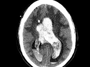 Third Stage Hemorrhage Meaning