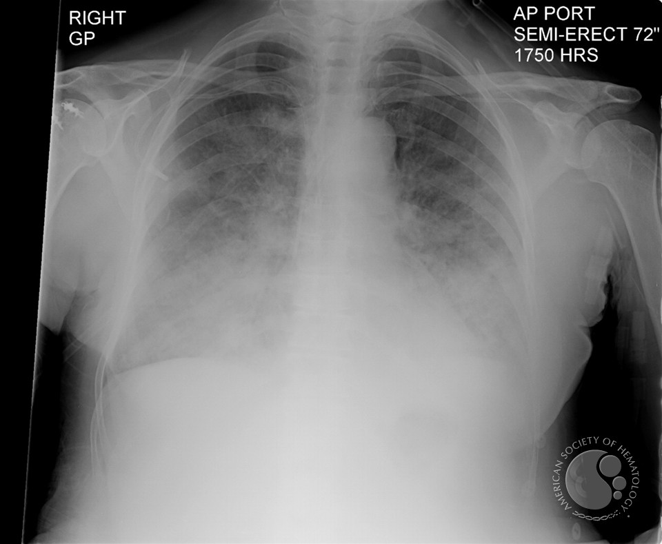 Transfusion Related Acute Lung Injury (TRALI) - 1.