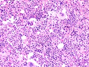 Recurrent AML following peripheral stem cell transplant - 1.