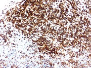 Recurrent AML following peripheral stem cell transplant - 8.
