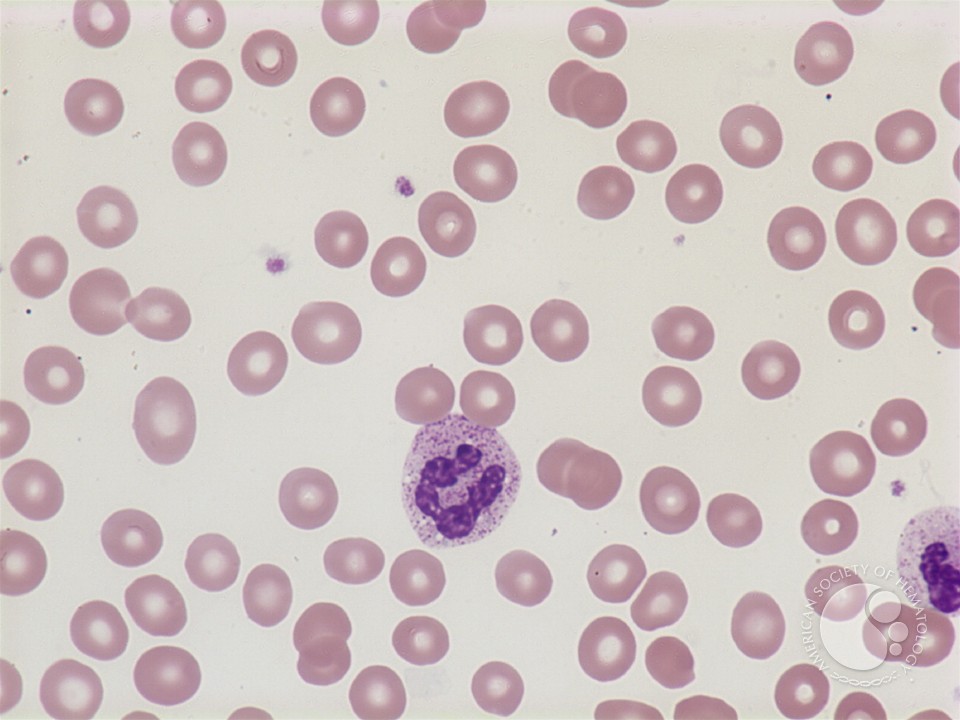Normochromic normocytic anemia - 1.