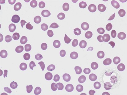 test nrbc 0 blood at room in agglutinin disease clotting cold Blood temperature test nrbc 0 blood at room in agglutinin disease clotting cold Blood temperature