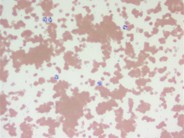 Cryoglobulin-induced RBC agglutination - 2.