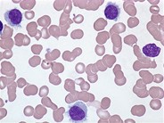 Hairy cell leukemia - 1.