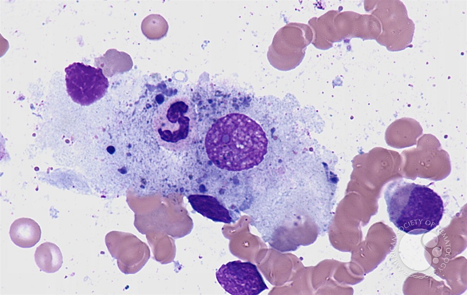Макрофаги 1 3. Макрофаги гистология. Макрофаги в крови. Фагоцитоз лейкоцитов. Макрофаги, гистиоциты фагоцитоз гистология.