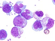 Pheresis collection post G-CSF therapy - 3.