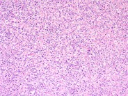 Diffuse large B-cell lymphoma, T-cell/histiocyte rich variant - lymph node - 1.