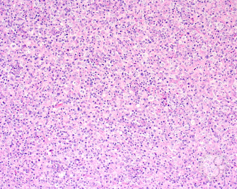 Diffuse large B-cell lymphoma, T-cell/histiocyte rich variant - lymph node - 1.
