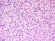 Diffuse large B-cell lymphoma, T-cell/histiocyte rich variant - lymph node - 2.